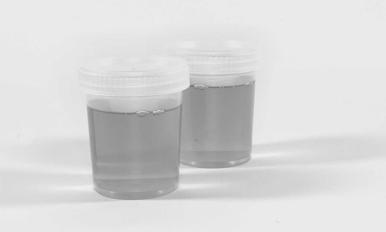 urine infection image